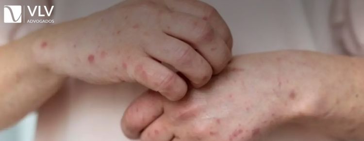 Quais os direitos do consumidor em casos de alergia ao produto?
