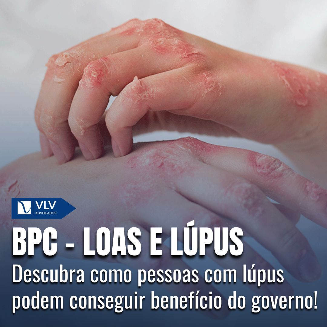 BPC - Loas e Lúpus: Entenda seu direito!