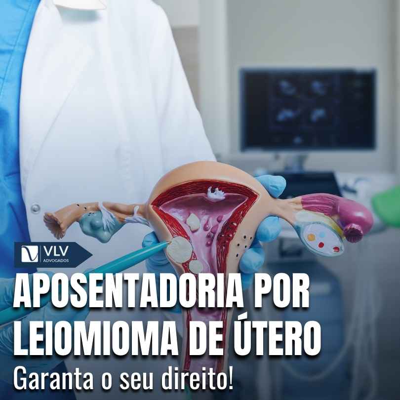 Blog Previdenciário 14 Aposentadoria por leiomioma de utero