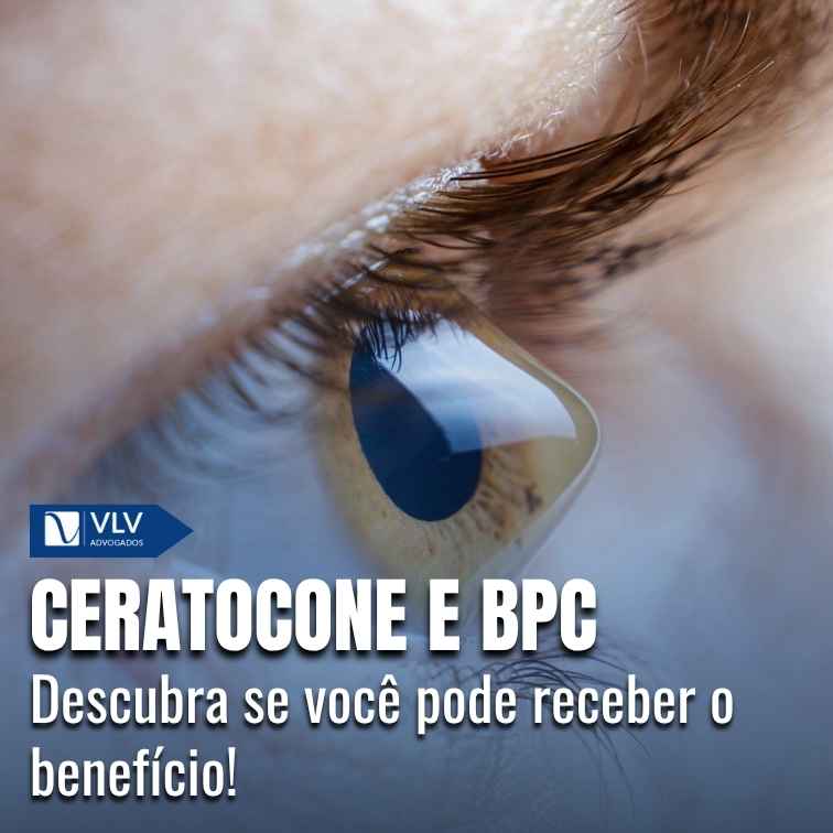 Ceratocone dá direito ao BPC LOAS pelo INSS