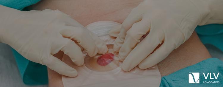 Imagem representando colostomia. 